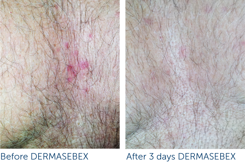 Results before & after DERMASEBEX